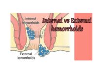What are Internal and External Piles? There are two main types: internal piles and external piles, and they differ based on their location, symptoms, and treatment approaches.