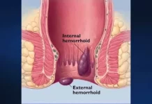 What Are the Causes and Treatment Options for Piles? Piles can lead to symptoms such as pain, itching, bleeding, and discomfort during bowel movements.